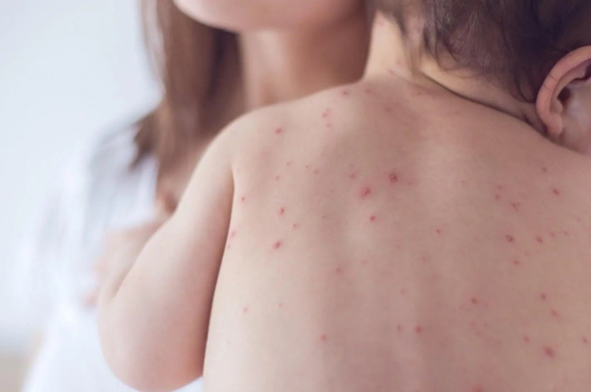 Cпалах кору в Україні: що треба знати про хворобу і як захистити себе